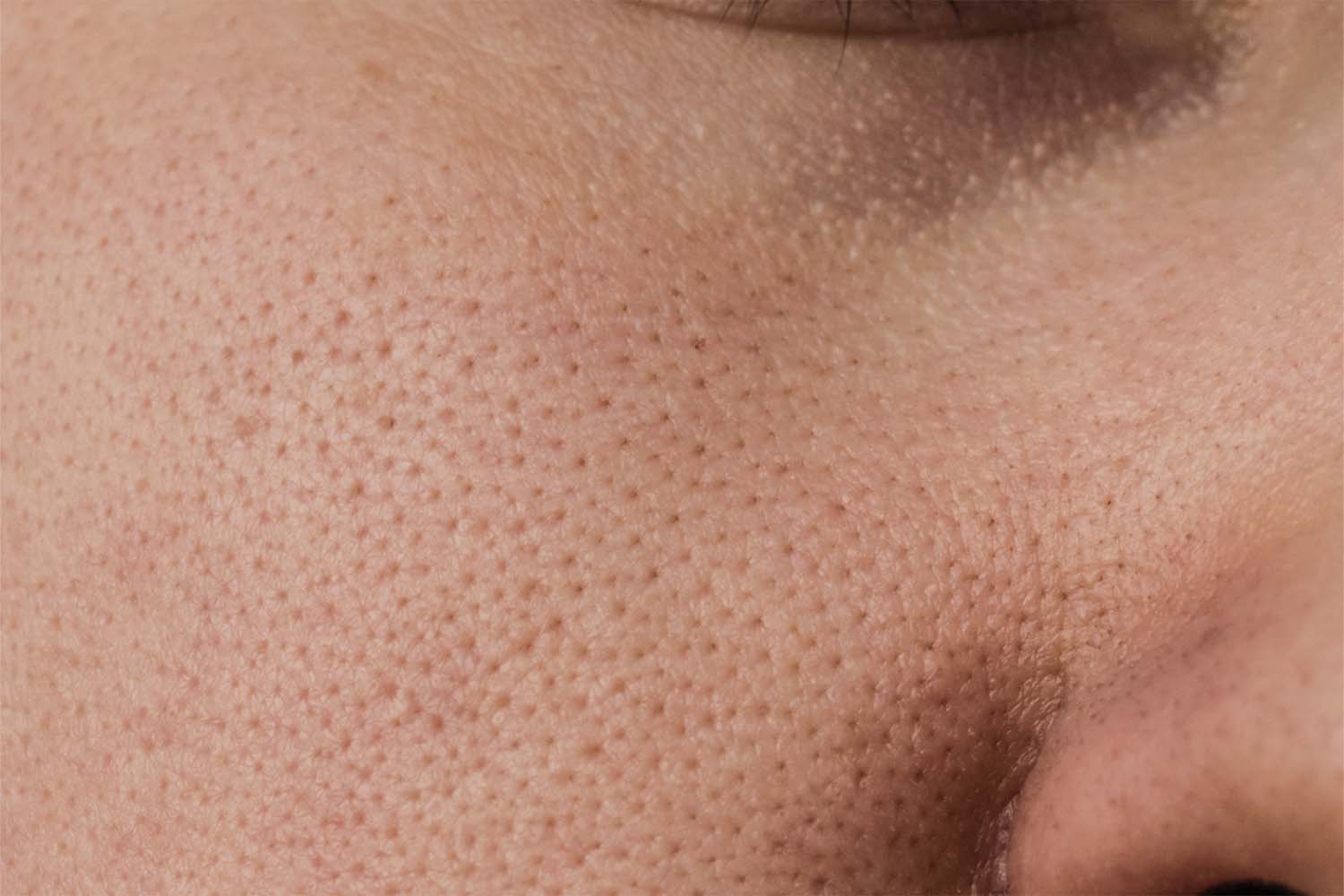 Clogged Pores